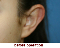 plastic-surgery-prominent-ear 